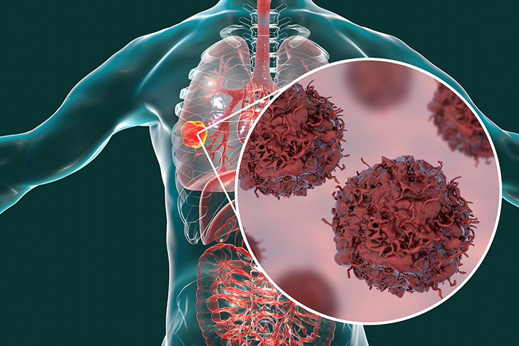 10 � 15% des cancers du poumon surviennent chez les non-fumeurs