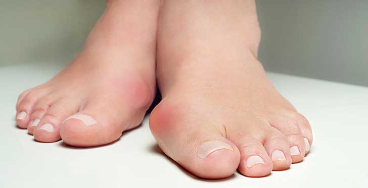 Comment soulager un hallux valgus ?
