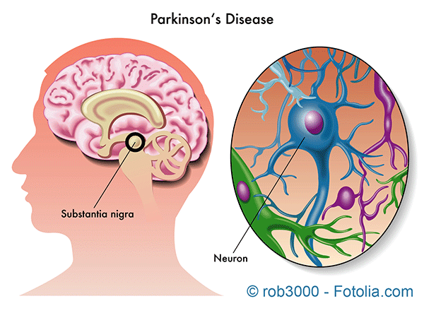 Le plan Parkinson de l