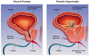 Le sur-diagnostic du cancer de la prostate