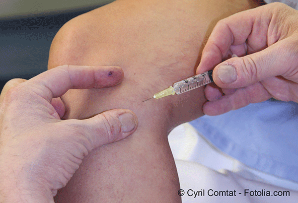 Varices et insuffisance veineuse